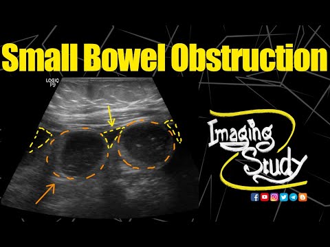 Video: S-ar observa o obstrucție intestinală la o ecografie?