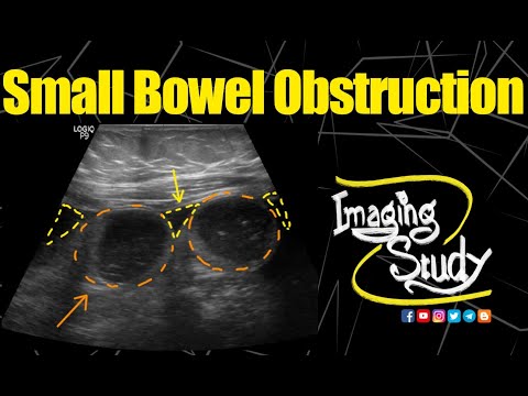 Small Bowel Obstruction