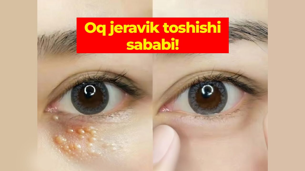Oq jeravik toshishi sababi nima?