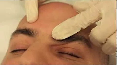Sebaceous Hyperplasia removal