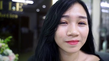 Bác sĩ chia sẻ: cắt mí sau bao lâu thì đẹp?