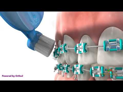 ბრეკეტის დაწებება  და კბილების წმენდა