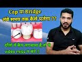 Tooth cap लगवाने के बाद क्या करे जिससे हमेशा अच्छा रहे ?? Precautions for tooth cap and Bridge