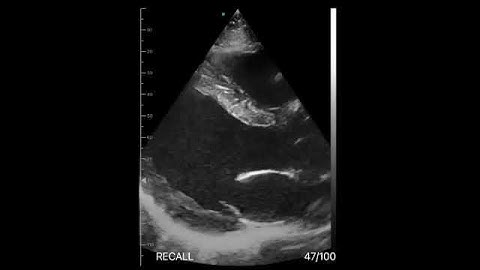 Eagleview Handheld Whole-body Ultrasound Scanner: Cardiac imaging