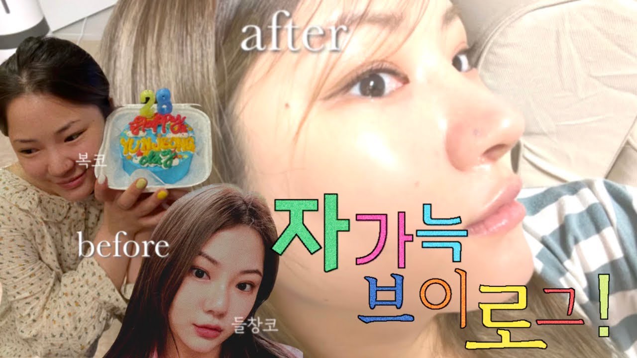이렇게 솔직할 수 있을까? 자가늑연골 코 재수술 리얼 경과 후기 브이로그 ✨