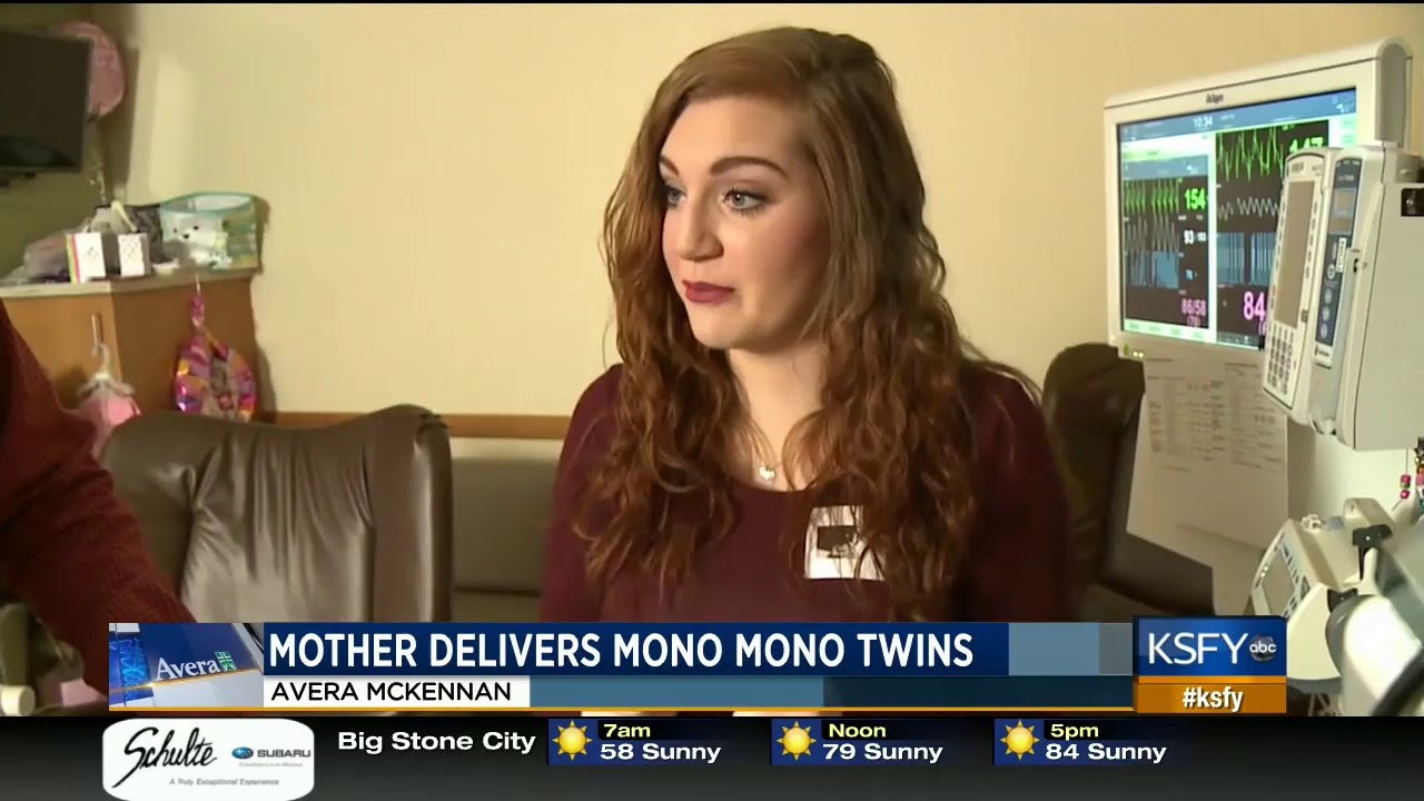 Mother's pregnancy journey with Mono Mono twins - Medical Minute - YouTube