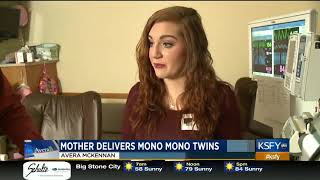 Mother's pregnancy journey with Mono Mono twins - Medical Minute Mother's pregnancy journey with Mono Mono twins - Medical Minute