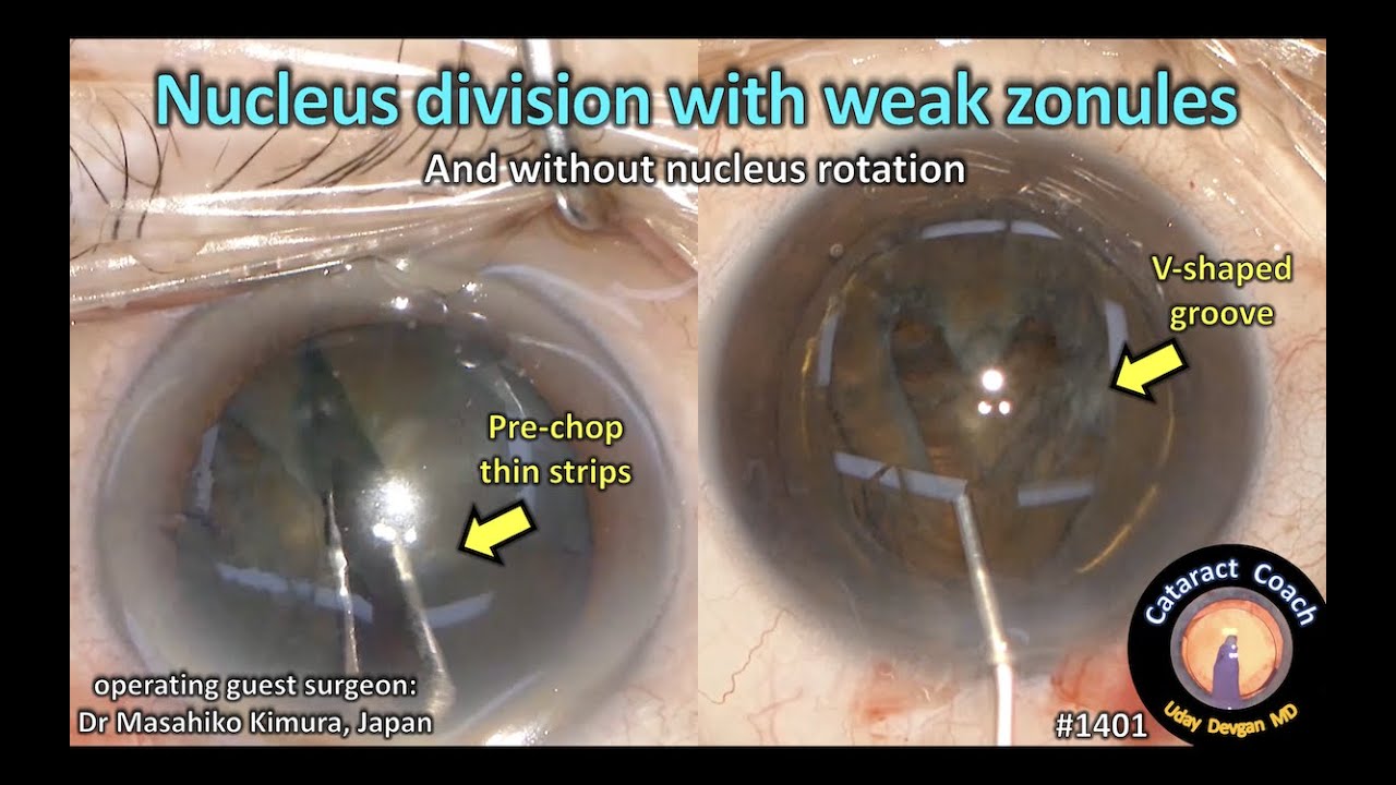 CataractCoach 1401 nucleus division with weak zonules YouTube