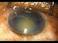 Small incision cataract surgery  in 7 minutes unedited