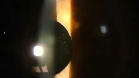 Iris transillumination and Pseudophakia