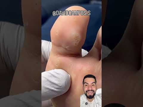 VERRUGA PLANTAR