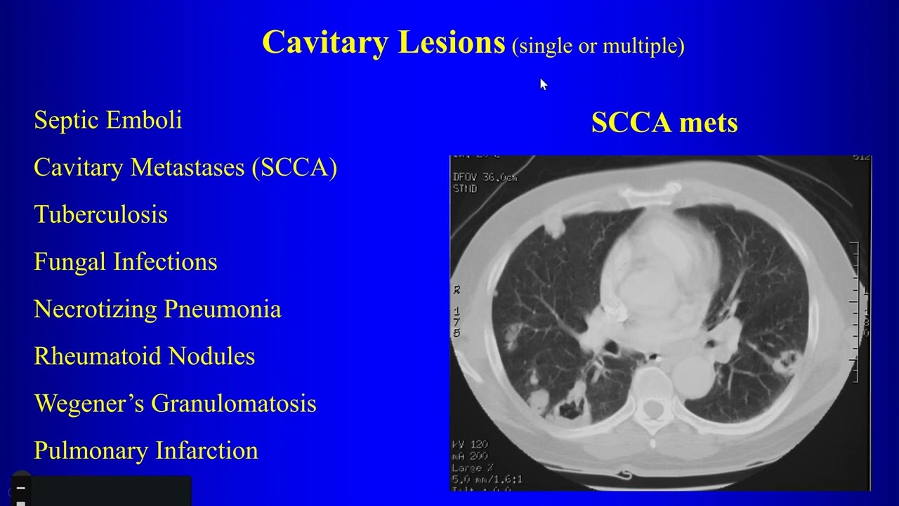 5 Multiple Nodules and Cavitary Lesions