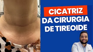 Cicatriz da cirurgia da tireoide