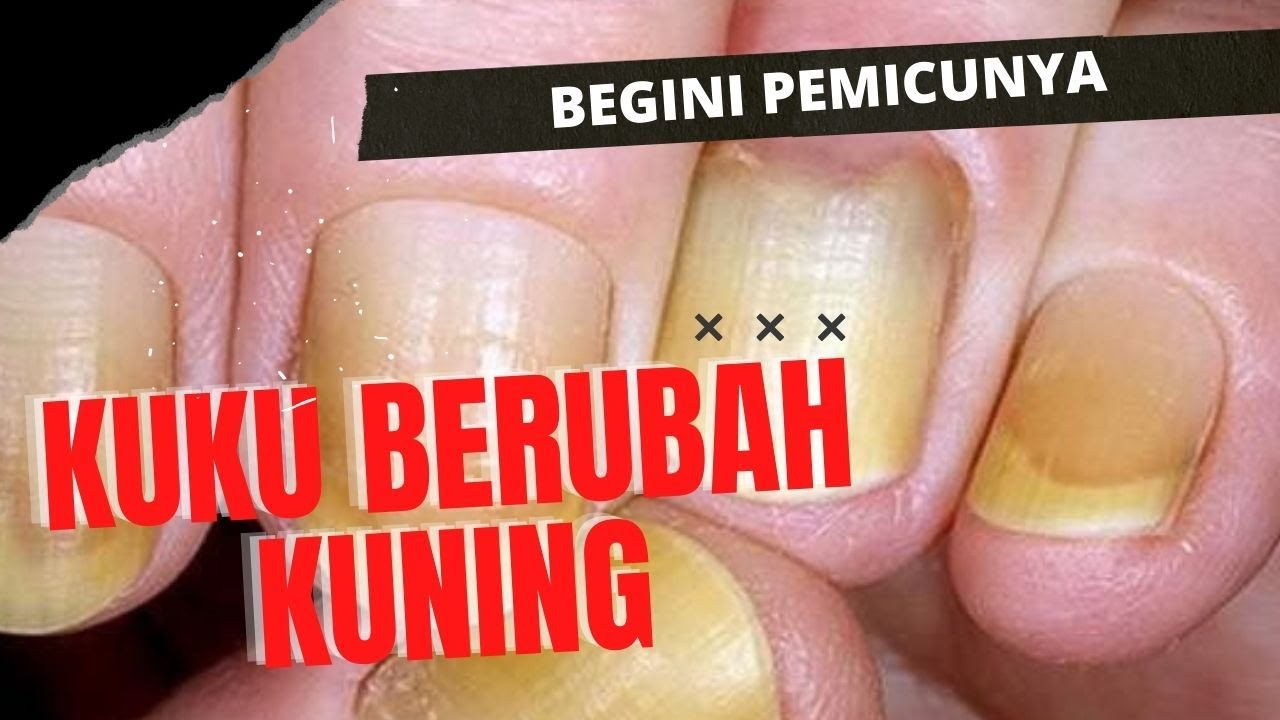 Kuku Tiba-Tiba Kuning, Tanda Penyakit Apa?