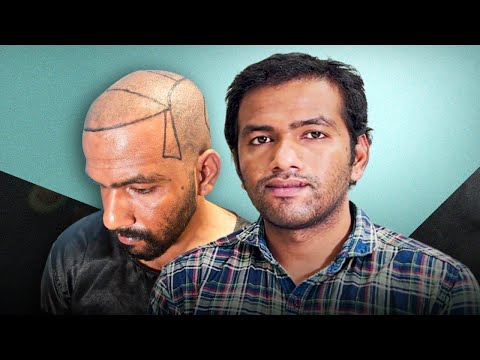 Hair Transplant Case Study: Visible Results in 5 Months 😊 | Bangalore | New Roots