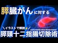 膵臓癌に対する手術 「膵頭十二指腸切除術:PD」の術式と看護についてわかりやすく解説!