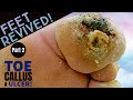 Feet Revived, Part 2: Trimming of the Thick Big Toe Callus and Wound Care