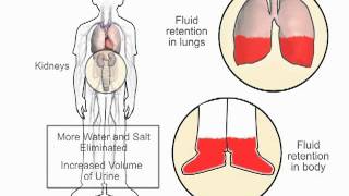 How diuretics work in heart failure - www.heartfailurematters.org Resimi