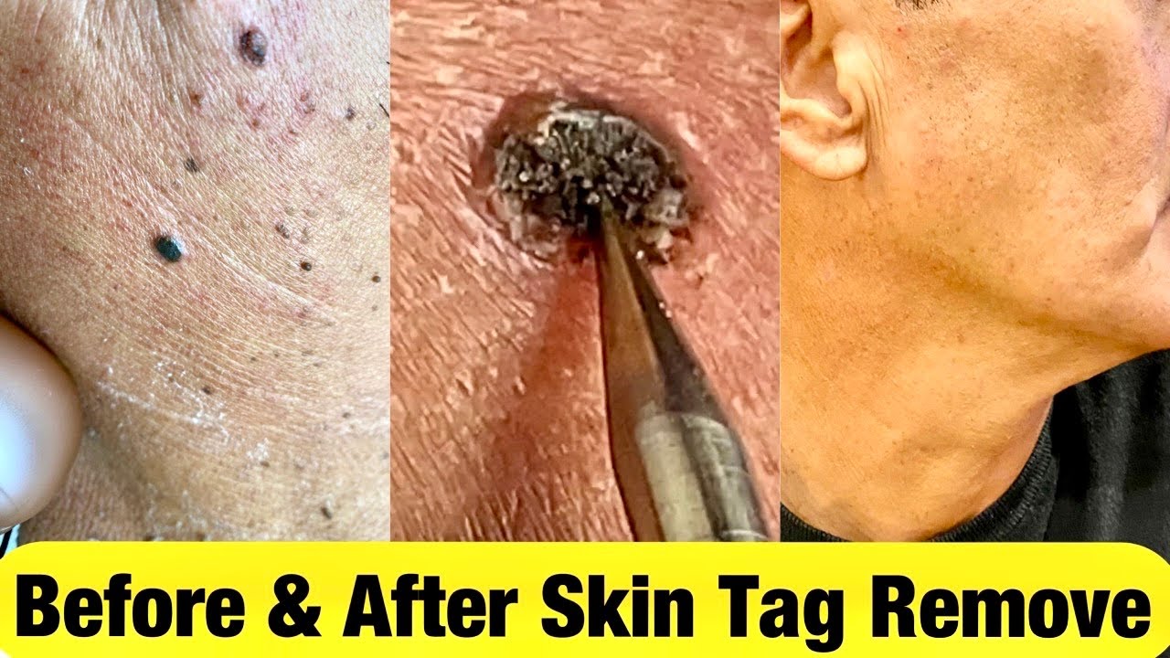 WARTS & MOLE CAUTERY PROCEDURE EASY & FAST YouTube