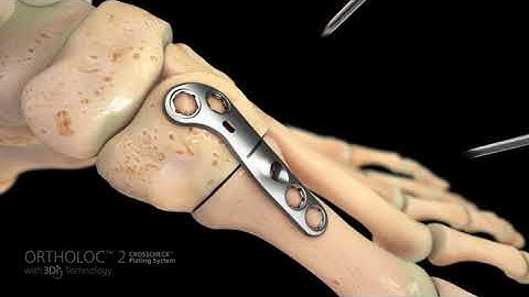 CROSSCHECK LAPIDUS ORTHOLOC 3Di