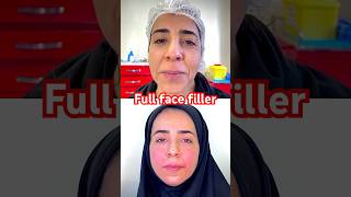 Full Face Contour Transformation | Jawline, Cheeks, chin, Nasolabial Folds & Lips 💉 #montrealbeauty