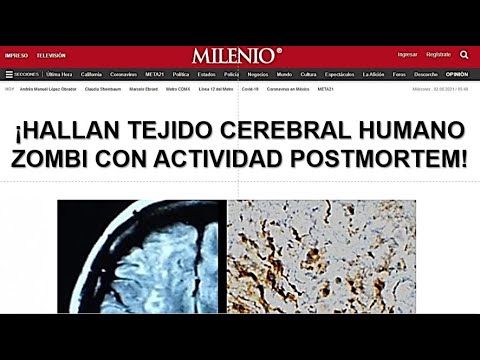 Vídeo: Análisis Post Mortem De Cambios Neuroinflamatorios En La Enfermedad De Alzheimer Humana