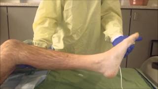 Ankle clonus