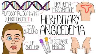 Hereditary Angioedema Explained Clearly