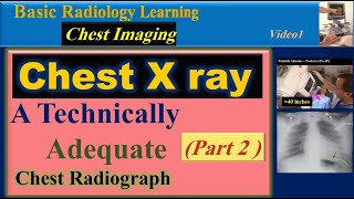 Chest X Ray , A Technically Adequate Chest Radiograph Par2