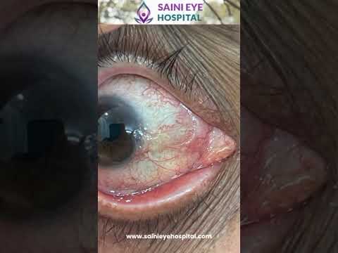 Cancer Of The Eye Ocular Surface Squamous Neoplasia OSSN