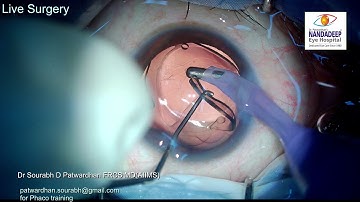 Soft cataract carousel technique Live surgery from Nandadeep Eye Hospital Dr Sourabh Patwardhan