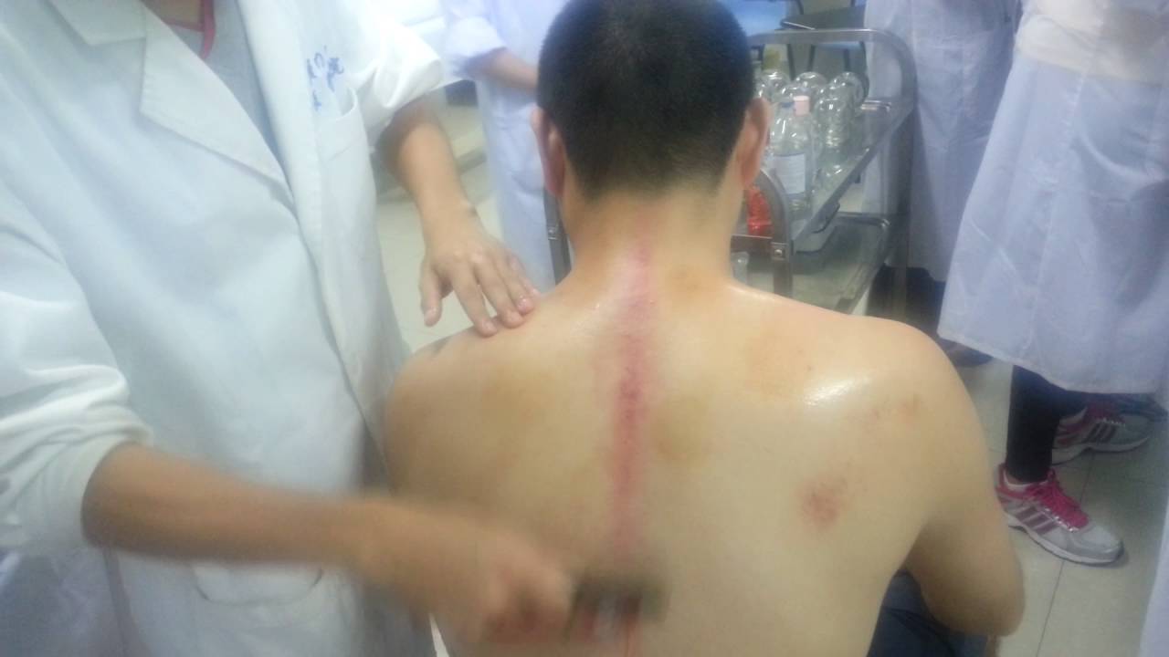 Como eliminar completamente a dor de tensão muscular do trapézio com Gua sha magdalena vs america