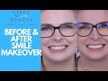 Before and After Smile Transformation Cosmetic Dentistry