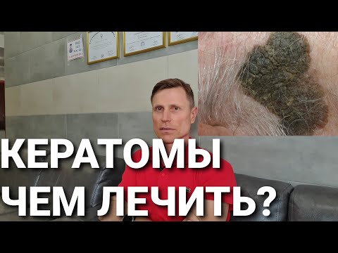 Кератомы. Чем лечить?