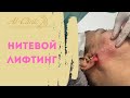 Мгновенная подтяжка лица | ЛИФТИНГОВЫЕ НИТИ💉