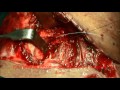 Oesophagus fistula repair