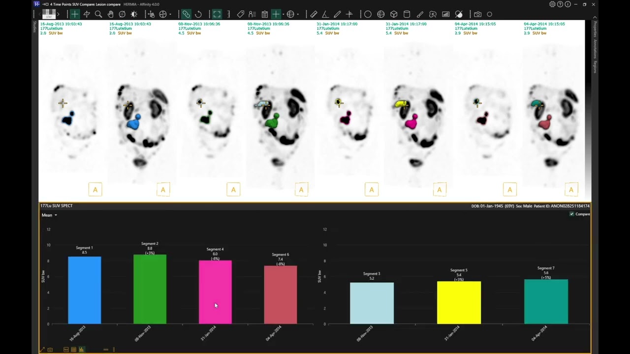 Lesion tracking through time in Hermia Multimodality Viewer