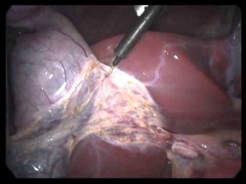 Lap. Cholecystectomy (unedited-212)-Simple Chronic Cholecystitis With Appendectomy