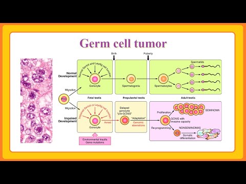 Video: Neoplazie cu celule germinale in situ?
