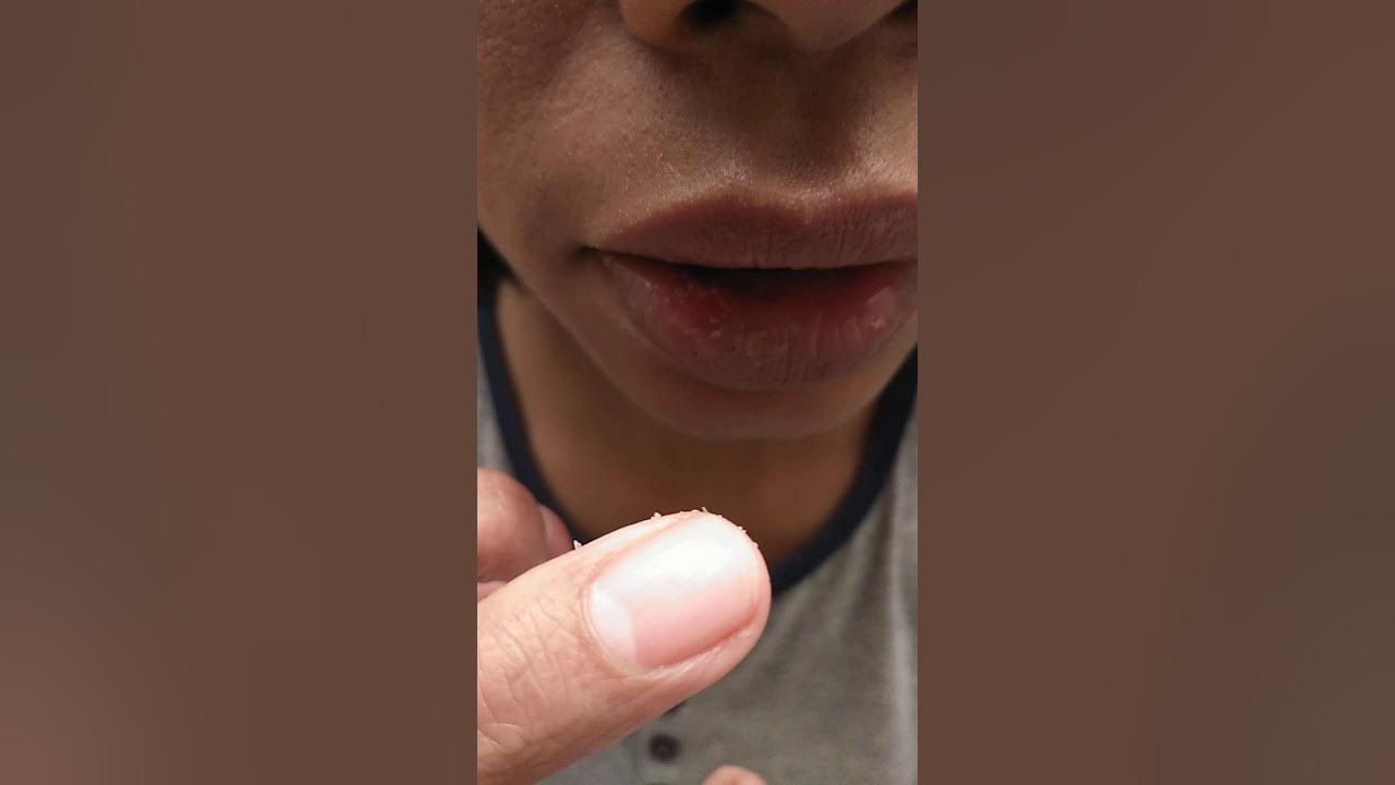 putting-salt-on-canker-sore-mouth-ulcer-youtube