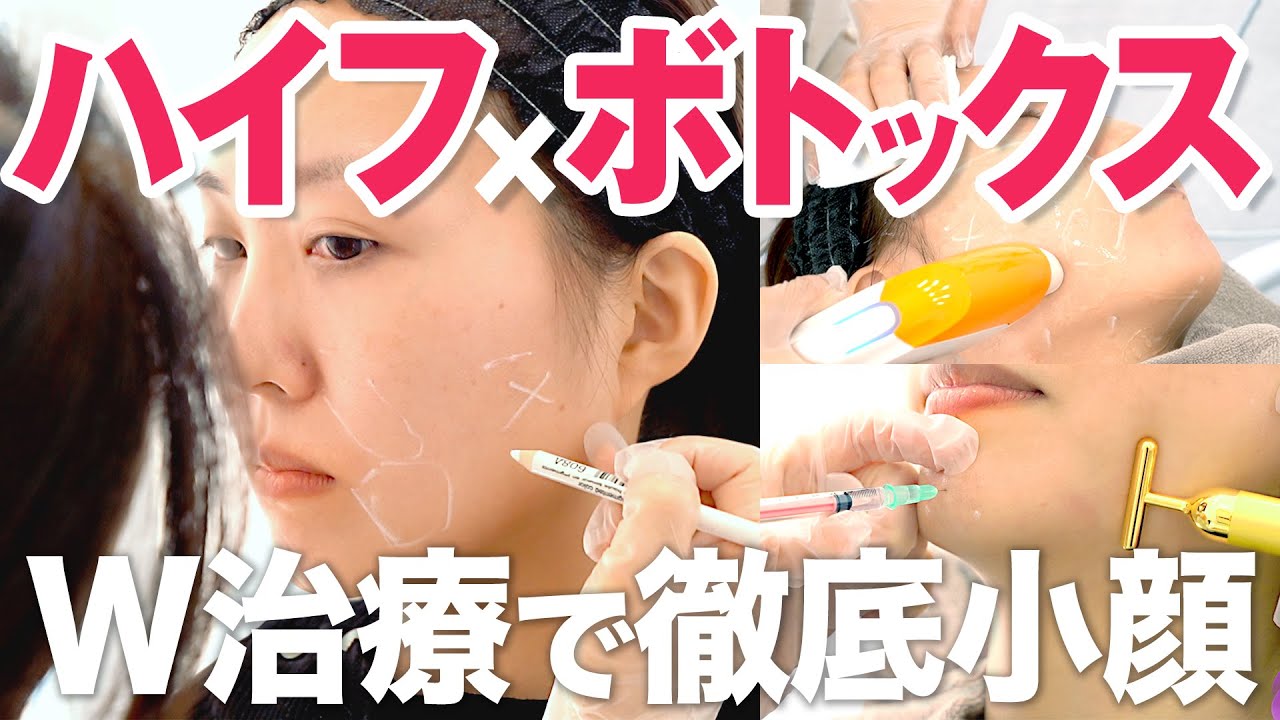 ハイフ×ボトックス】オーダーメイド施術体験レポ！1か月後の驚異的な