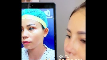 Nâng Mũi Cấu Trúc Sửa Lại - Sở Hữu Dáng Mũi Cao Sang Và Đẹp Tự Nhiên