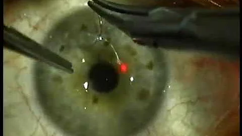 Laurie Sullivan LASIK flap suture