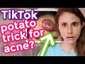 Tiktok POTATO ACNE TRICK DIY: Dermatologist Reacts| Dr Dray