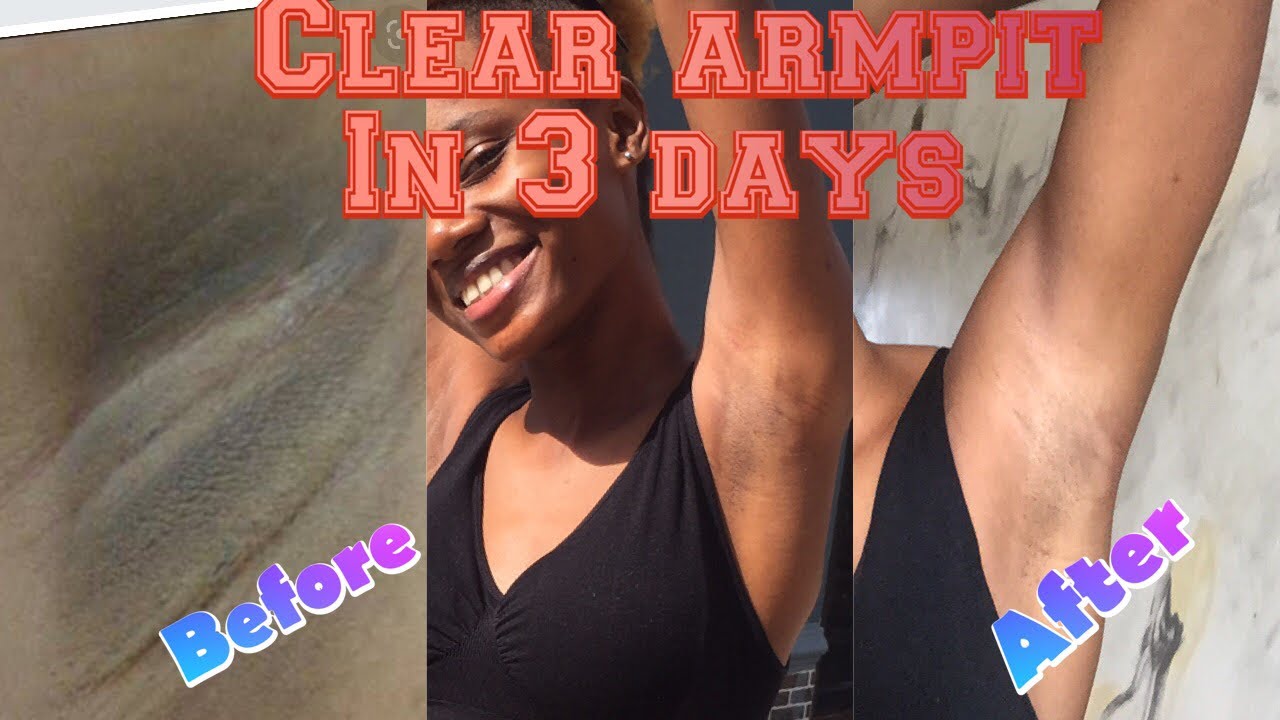 HOW TO LIGHTEN THE ARMPIT IN 3DAYS ( home remedy) YouTube
