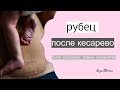 РУБЕЦ ПОСЛЕ КЕСАРЕВА | болит, ноет, спайки что делать?