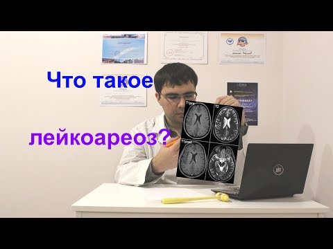 Лейкоареоз головного мозга: что это такое?