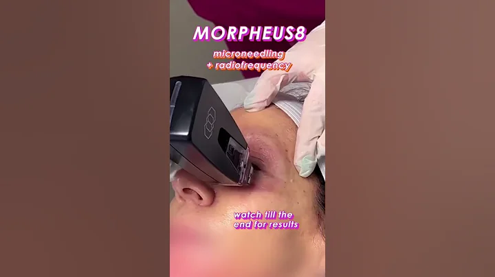 Morpheus8 Skin Tightening Microneedling Face Treatment | New Skin Laser #shorts