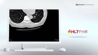Lung Cancer Screening Chest CT images analyzed by AI algorithms by Smart Reporting