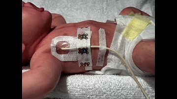 Pigtail Catheter Placement for Pneumothoraces in Neonates@McGlinnInstituteNeonatal